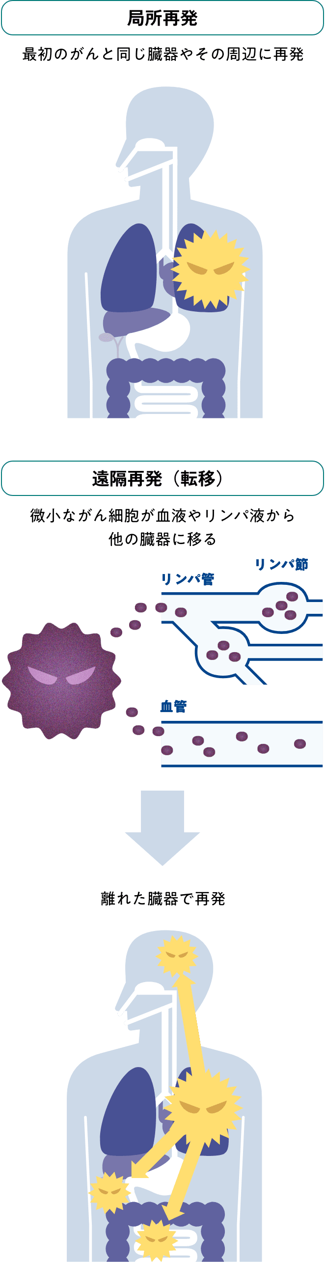微小ながん細胞が再発の原因イメージ