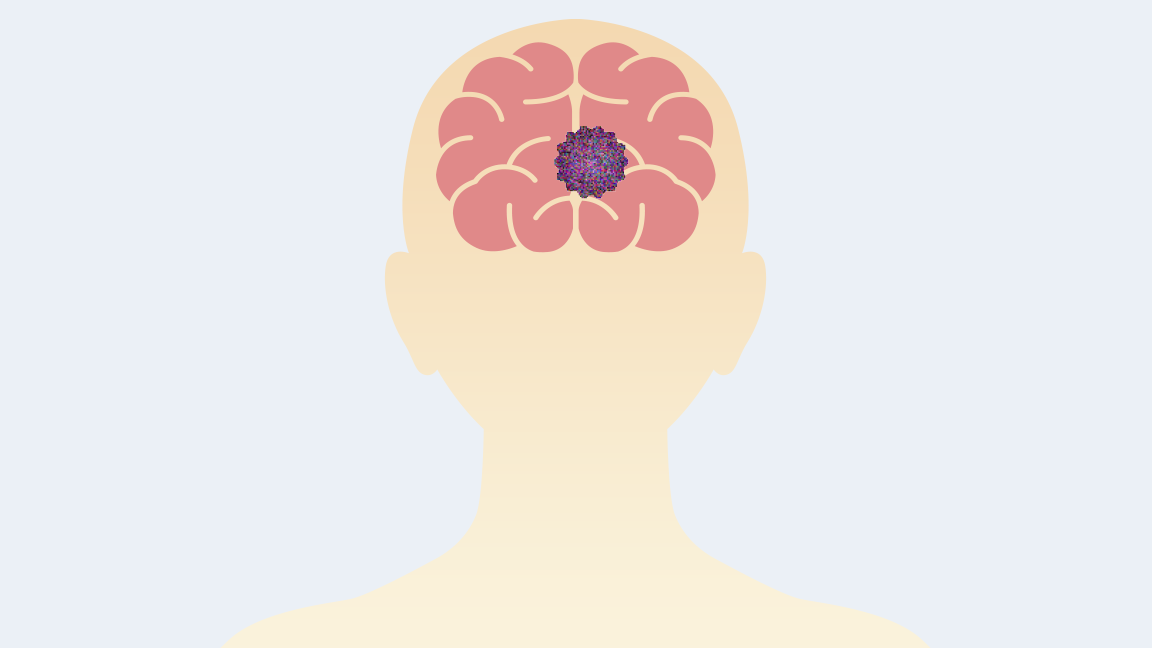 脳腫瘍イメージ
