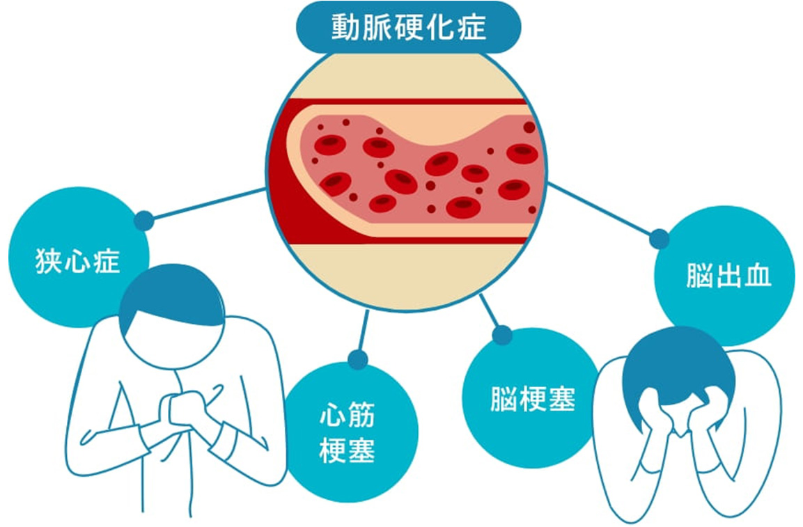 動脈硬化症が引き起こす狭心症、心筋梗塞、脳梗塞、脳出血のイメージ図