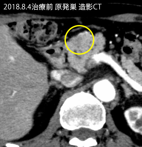2018年8月の原発巣画像