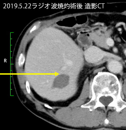 2019年5月の肝転移巣画像