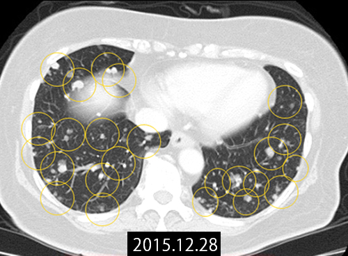 2015年12月の多発肺転移画像