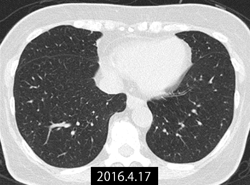 2016年4月治療後の肺転移巣画像